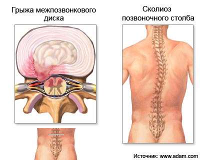hernia_intravertebralis2 copy